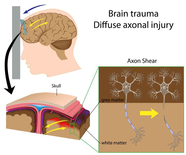 The Gravity of Concussions 2 concussion