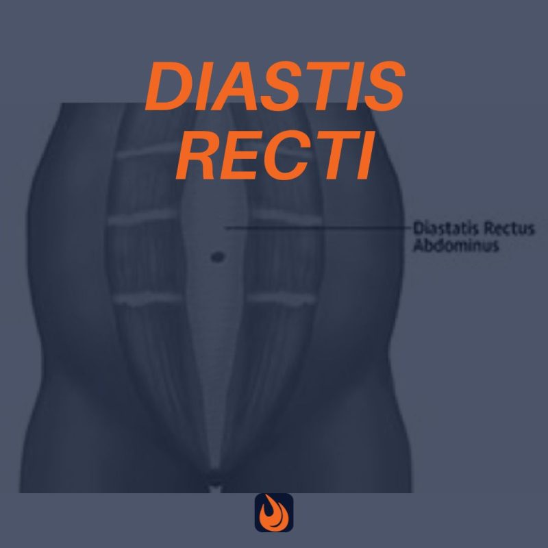 DIASTASIS RECTI