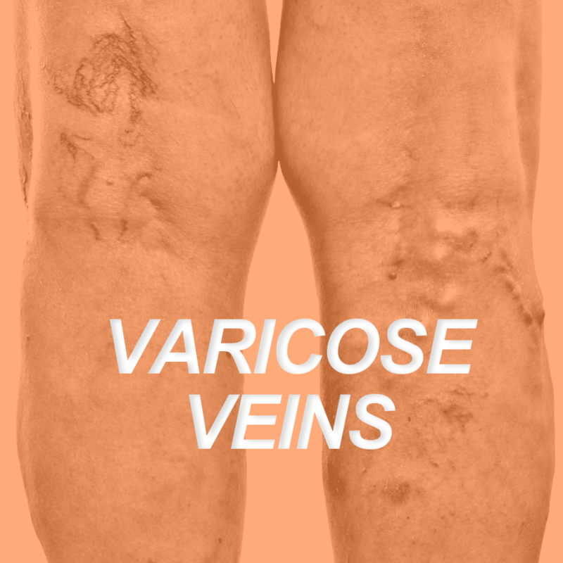 VARICOSE VEINS