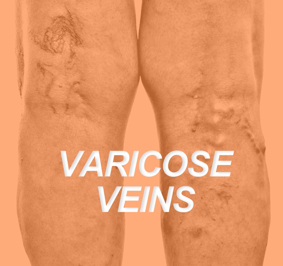 VARICOSE VEINS