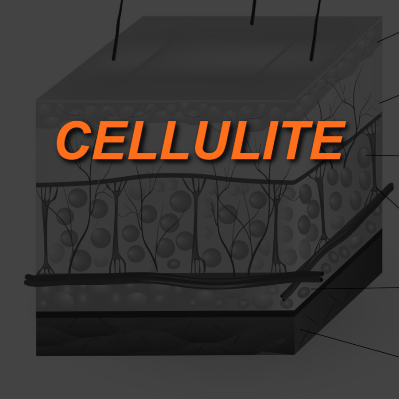 What is Cellulite and Why Do Women Get It? 2 CELLULITE IMAGE