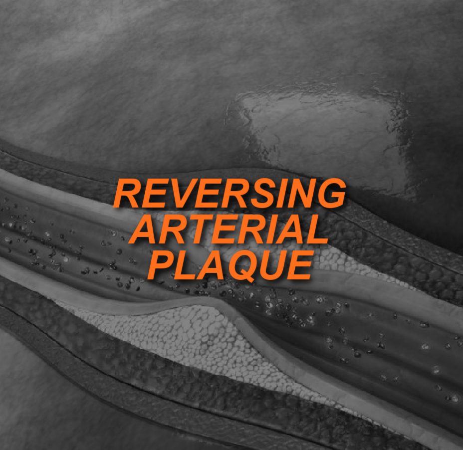 How Arterial Plaque May Be Reversed How Arterial Plaque May Be Reversed