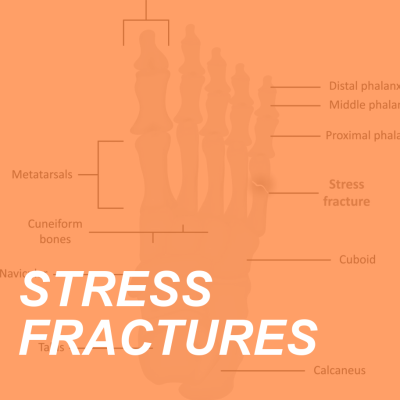 Bone up on Stress Fractures and Prevent the Pain 2 STRESS FRACTURES