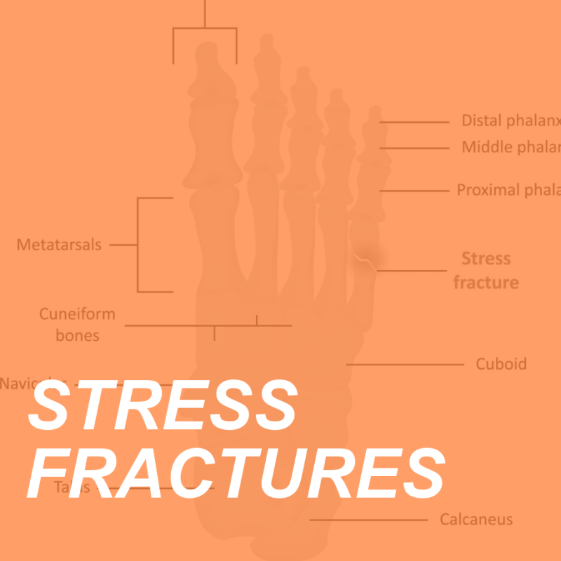 STRESS FRACTURES