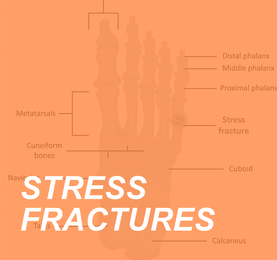 STRESS FRACTURES