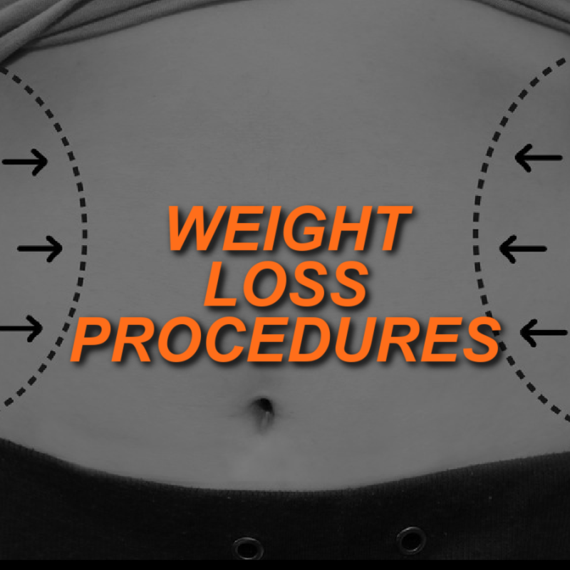 What Trainers Need to Know About Weight Loss Procedures 2 WEIGHT LOSS PROCEDURES