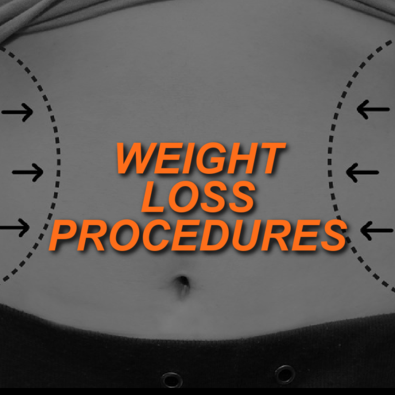 WEIGHT LOSS PROCEDURES