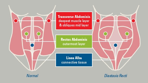 diastasis recti