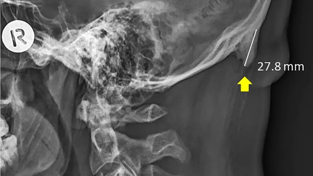 Teens Growing "Horns": How To Help Prevent Text Neck 2 Horns