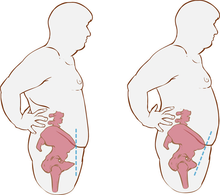 Understanding Pelvic Tilt Muscles and Function 2 Illustration Of A Forward Hip Tilt